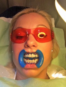 tandblekning-alexiskliniken